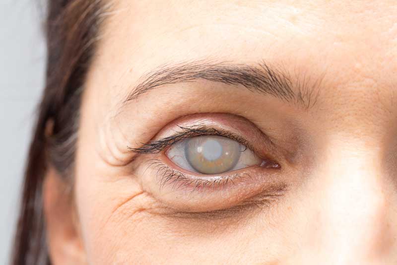Cataracts 16650 W. Bluemound Rd #400B<br />Brookfield, WI 53005<br />located inside of Milwaukee Eye Surgeons