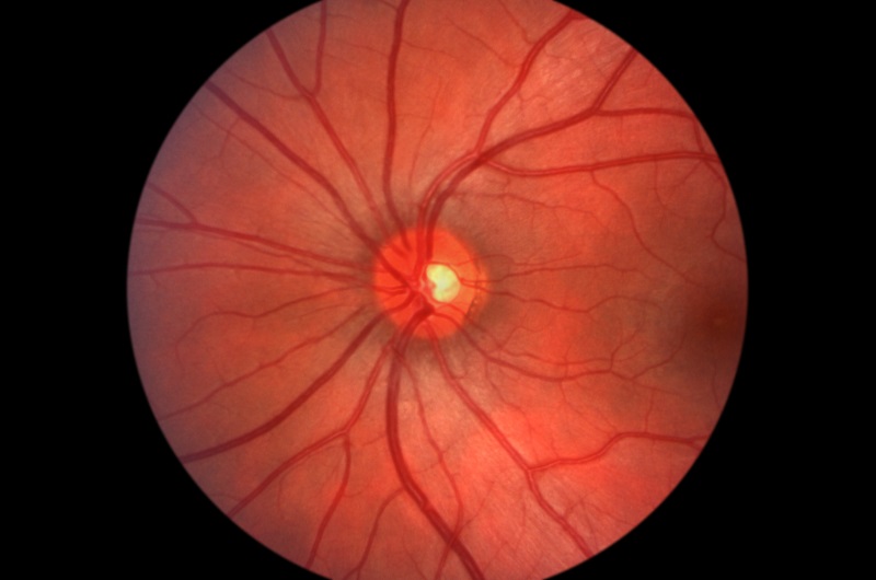 Glaucoma 16650 W. Bluemound Rd #400B<br />Brookfield, WI 53005<br />located inside of Milwaukee Eye Surgeons
